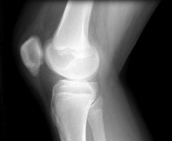 Остеохондропатия колена